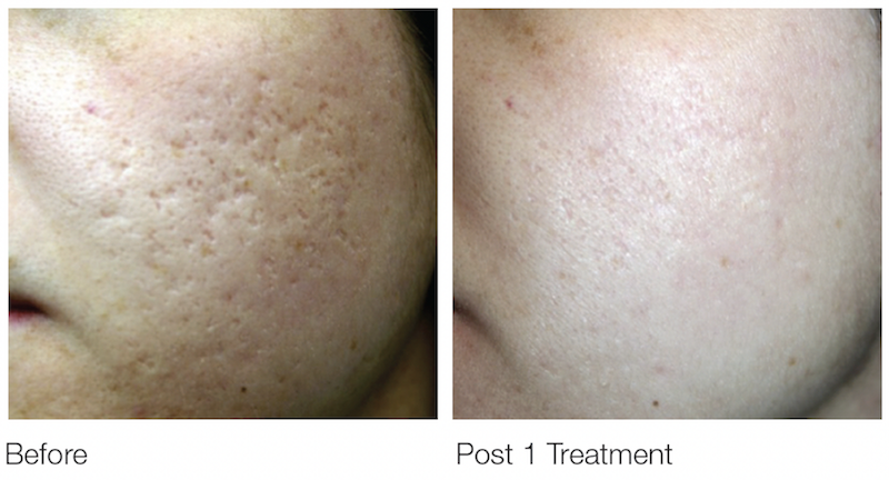 acne scar before and after treatment Hervey Bay