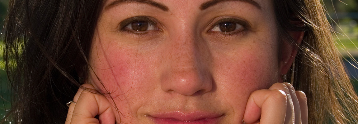 best rosacea removal treatment hervey bay