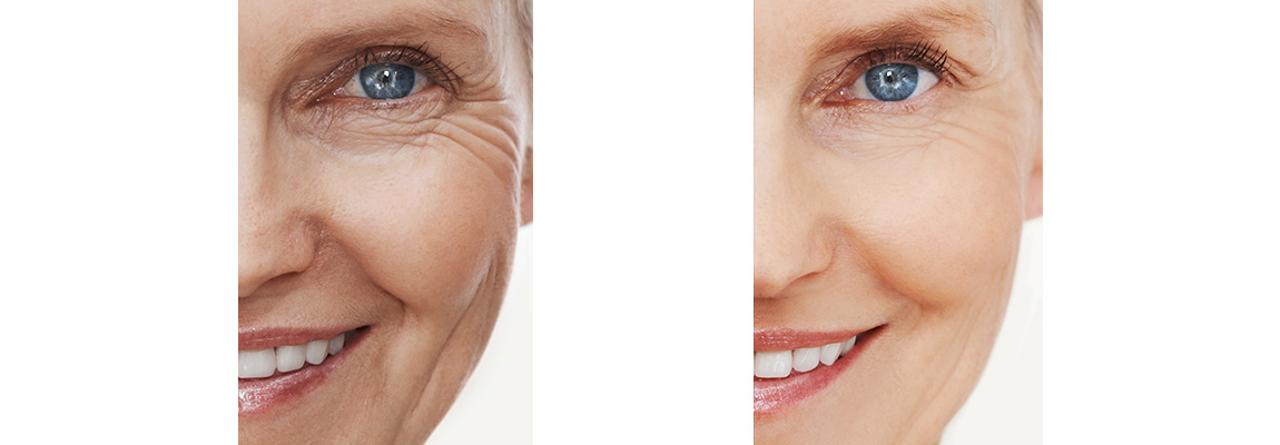 laser wrinkle removal hervey bay