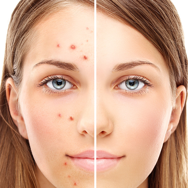 Acne and acne scar treatment