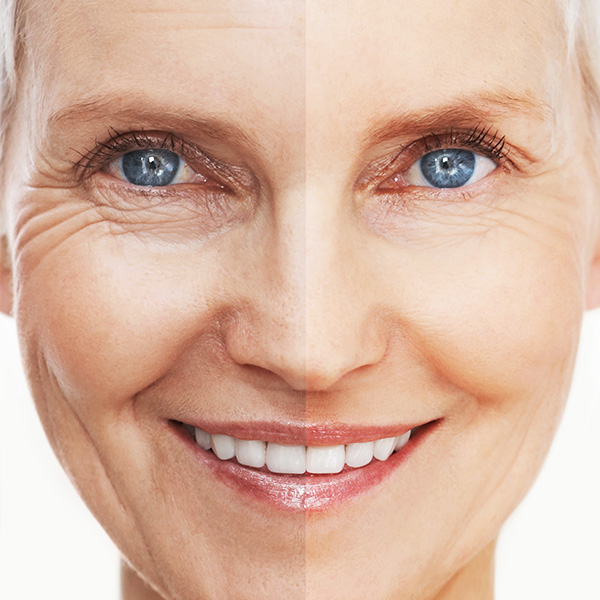Laser wrinkle reduction treatment