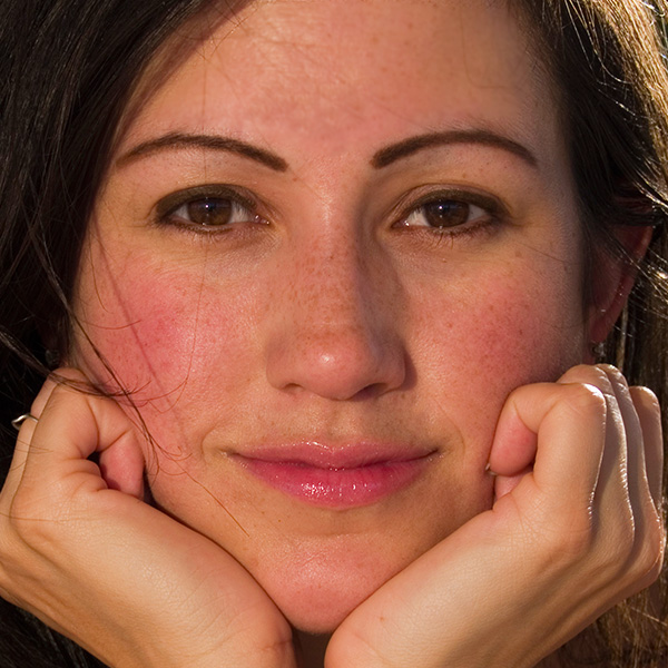 Rosacea treatment